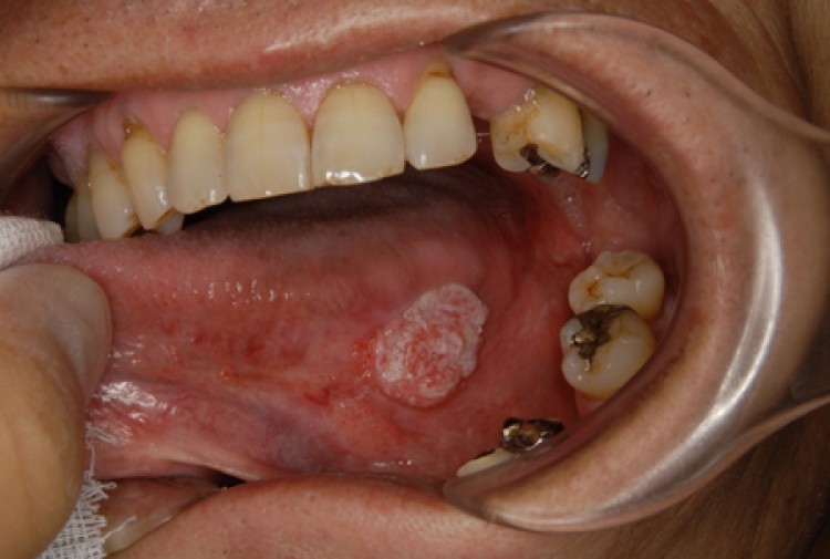 舌 癌 喉 の 痛み