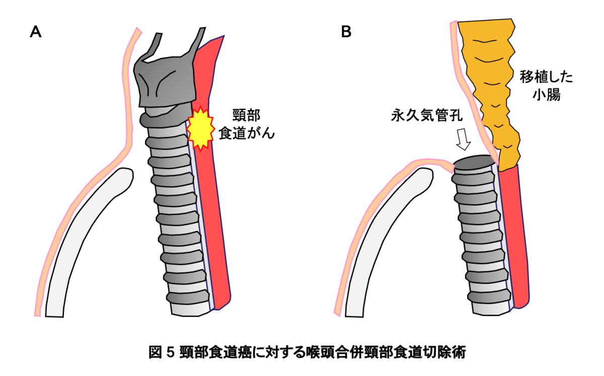 子宮頸部食道がんの症状