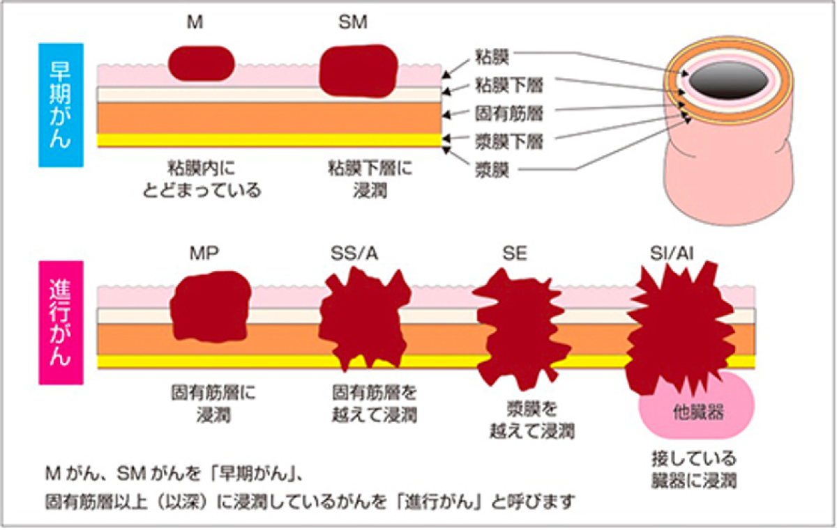 結腸直腸がん検査はどのくらいの頻度で必要ですか?